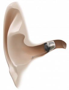 Oticon Invisible In Ear Hearing Aids Sydney